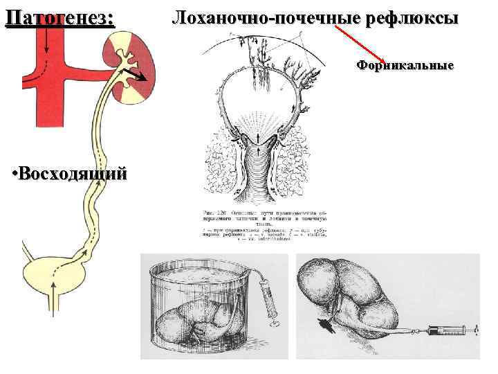 Патогенез: Лоханочно-почечные рефлюксы Форникальные • Восходящий 