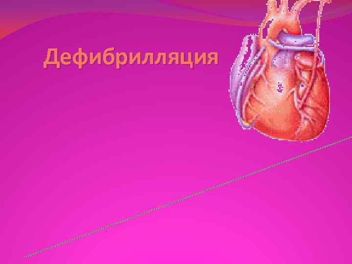 Дефибрилляция 