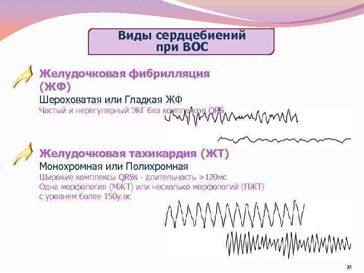 Виды сердцебиений при ВОС Желудочковая фибрилляция (ЖФ) Шероховатая или Гладкая ЖФ Частый и нерегулярный