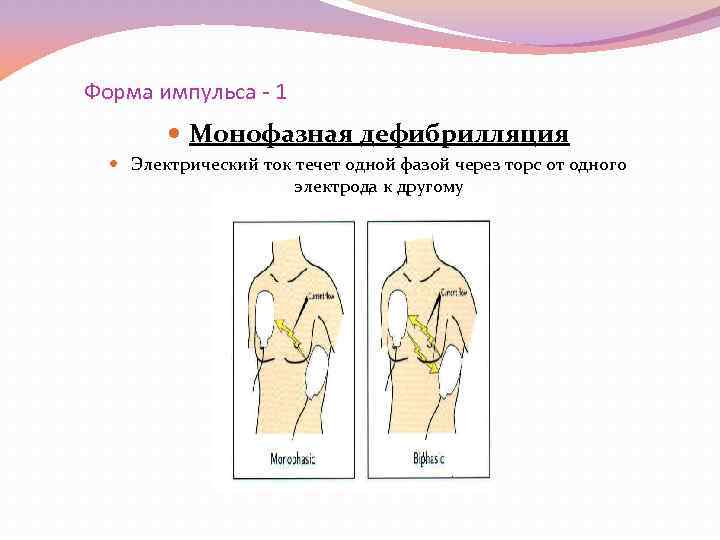 Форма импульса - 1 Монофазная дефибрилляция Электрический ток течет одной фазой через торс от