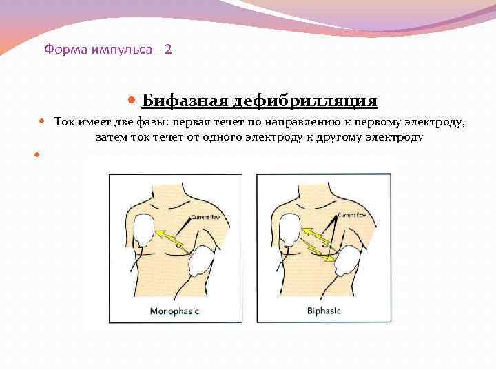 Форма импульса - 2 Бифазная дефибрилляция Ток имеет две фазы: первая течет по направлению