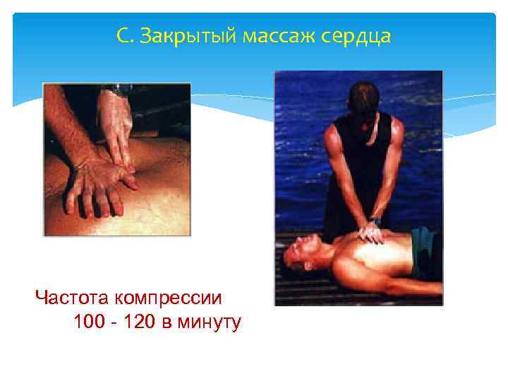 C. Закрытый массаж сердца Частота компрессии 100 - 120 в минуту 