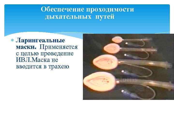  Обеспечение проходимости дыхательных путей Ларингеальные маски. Применяется с целью проведение ИВЛ. Маска не