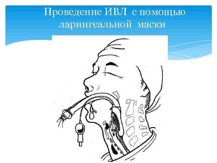 Проведение ИВЛ с помощью ларингеальной маски 