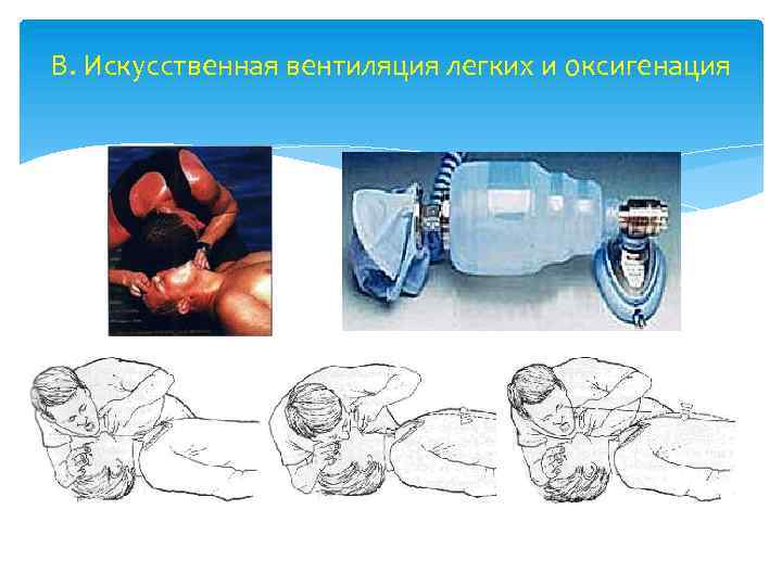 B. Искусственная вентиляция легких и оксигенация 