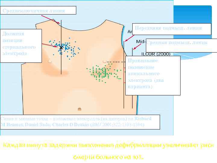 Среднеключичная линия Должная позиция стернального электрода Передняяя подмыш. линия Средняя подмыш. линия Правильное положение