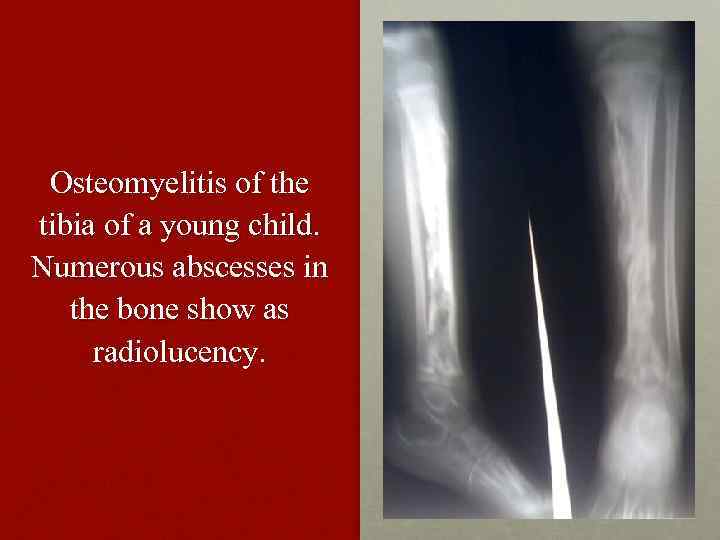 Osteomyelitis of the tibia of a young child. Numerous abscesses in the bone show