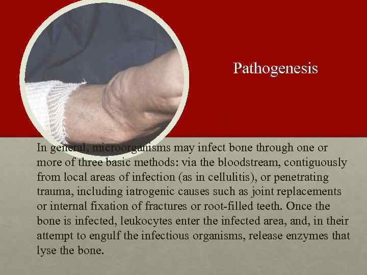 Pathogenesis In general, microorganisms may infect bone through one or more of three basic