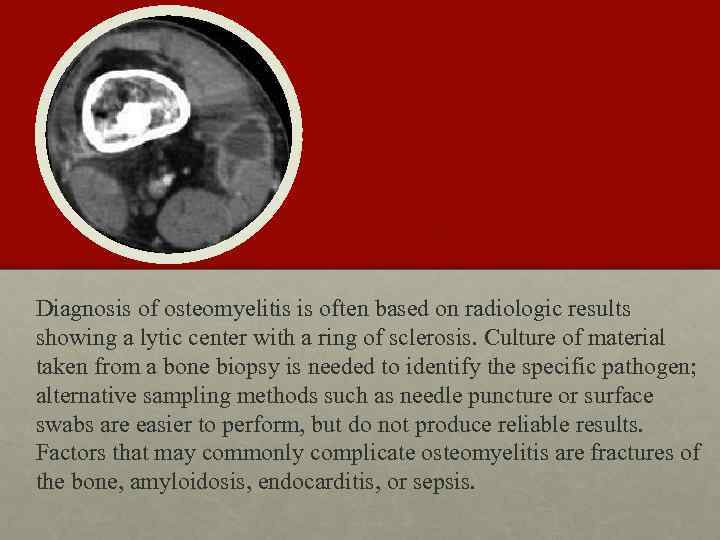 Diagnosis of osteomyelitis is often based on radiologic results showing a lytic center with