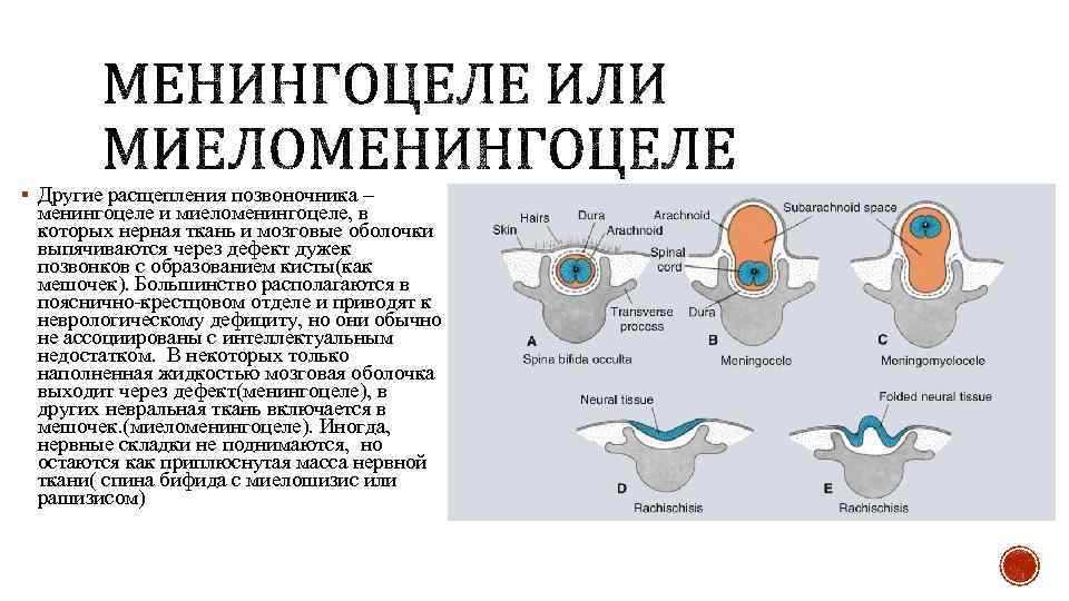 § Другие расщепления позвоночника – менингоцеле и миеломенингоцеле, в которых нерная ткань и мозговые