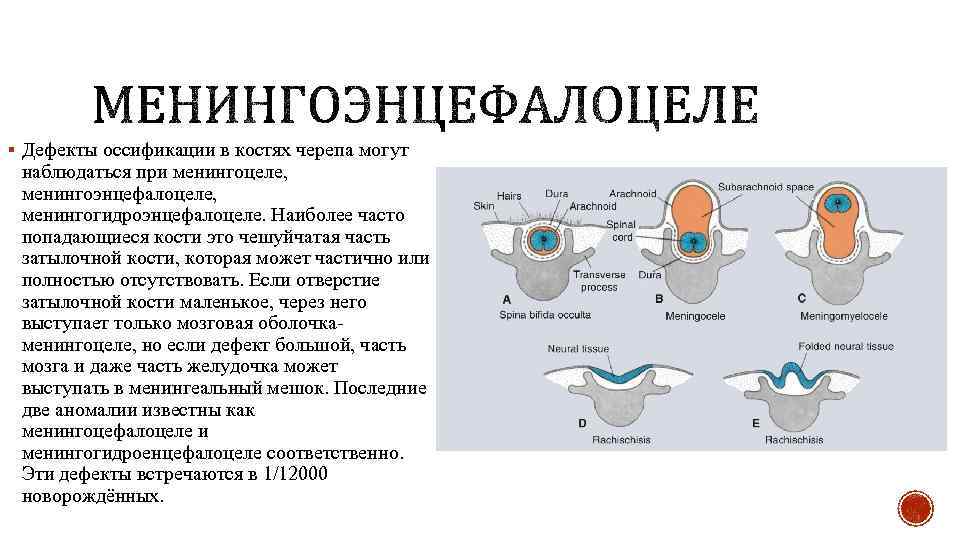 § Дефекты оссификации в костях черепа могут наблюдаться при менингоцеле, менингоэнцефалоцеле, менингогидроэнцефалоцеле. Наиболее часто