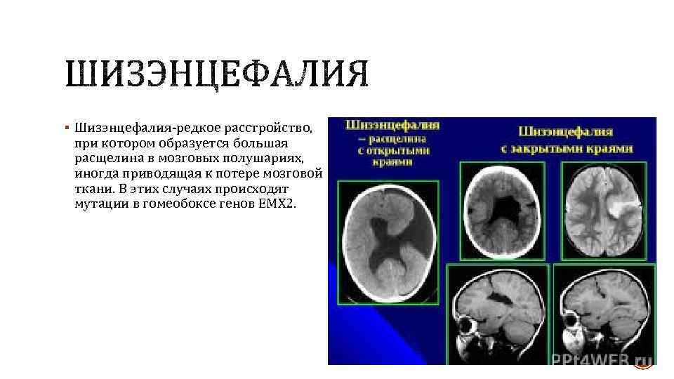 § Шизэнцефалия-редкое расстройство, при котором образуется большая расщелина в мозговых полушариях, иногда приводящая к