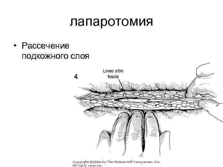 лапаротомия • Рассечение подкожного слоя 