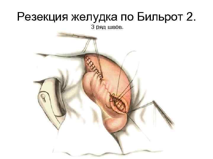 Резекция желудка по Бильрот 2. 3 ряд швов. 