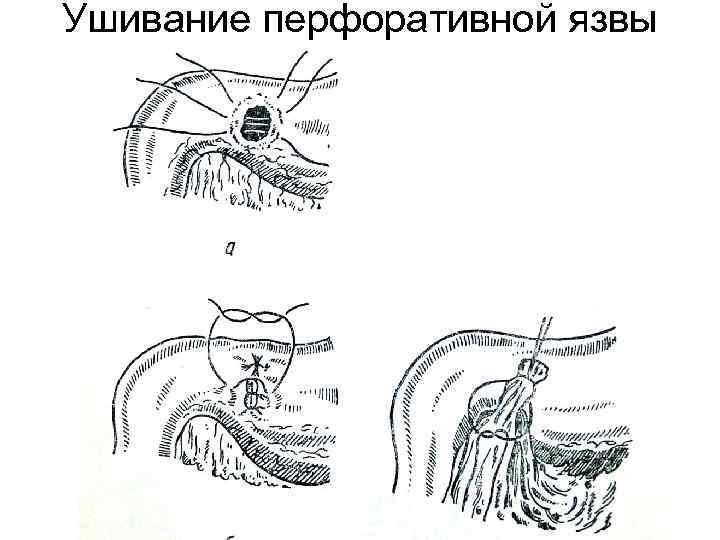 Ушивание перфоративной язвы 