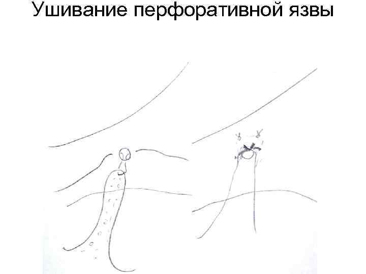 Ушивание перфоративной язвы 