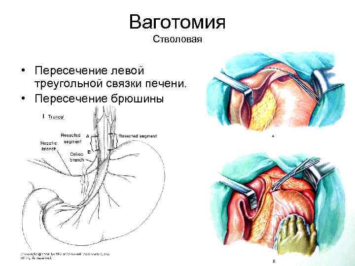 Ваготомия Стволовая • Пересечение левой треугольной связки печени. • Пересечение брюшины 