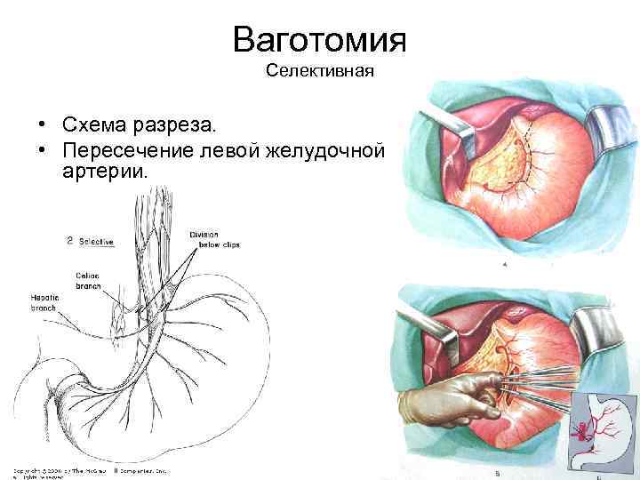 Ваготомия Селективная • Схема разреза. • Пересечение левой желудочной артерии. 