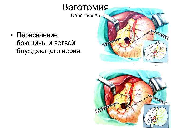 Ваготомия Селективная • Пересечение брюшины и ветвей блуждающего нерва. 