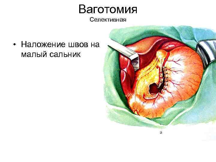 Ваготомия Селективная • Наложение швов на малый сальник 