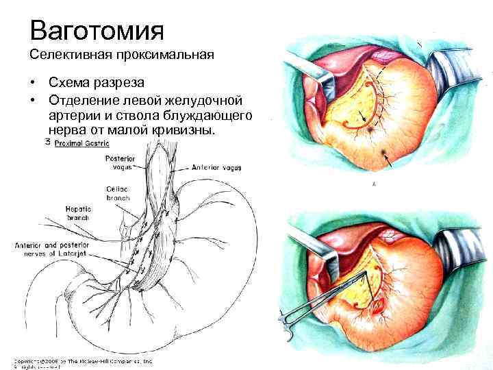 Ваготомия Селективная проксимальная • Схема разреза • Отделение левой желудочной артерии и ствола блуждающего