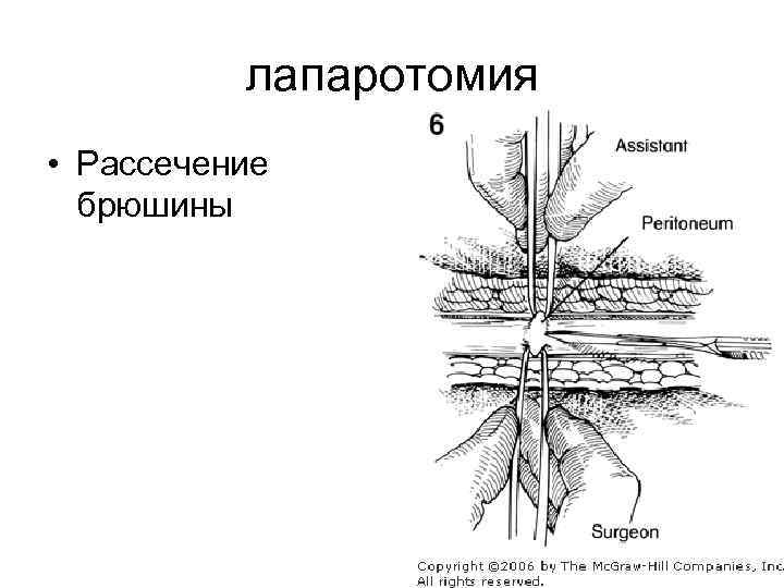 лапаротомия • Рассечение брюшины 