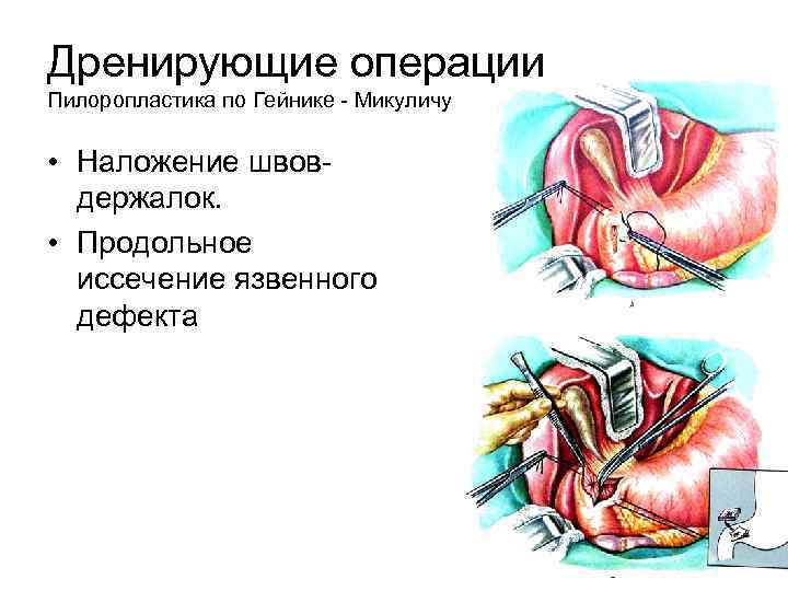 Дренирующие операции Пилоропластика по Гейнике - Микуличу • Наложение швовдержалок. • Продольное иссечение язвенного