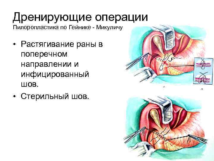 Дренирующие операции Пилоропластика по Гейнике - Микуличу • Растягивание раны в поперечном направлении и