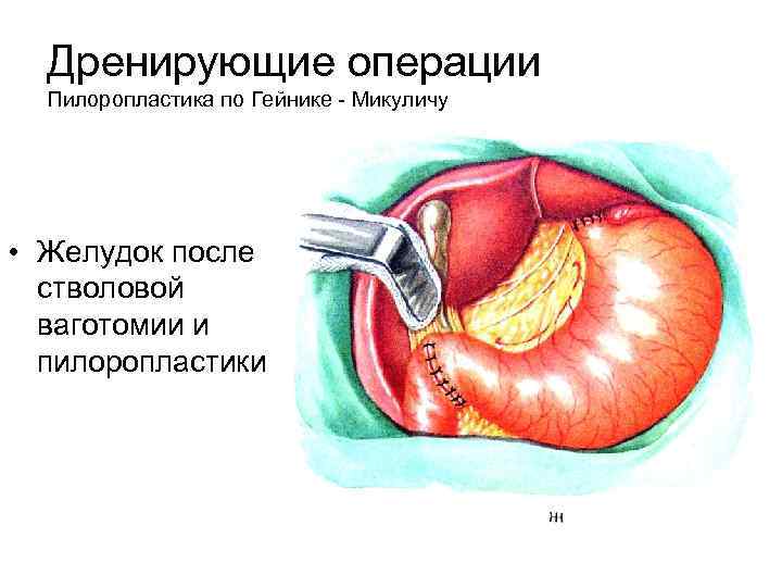 Дренирующие операции Пилоропластика по Гейнике - Микуличу • Желудок после стволовой ваготомии и пилоропластики