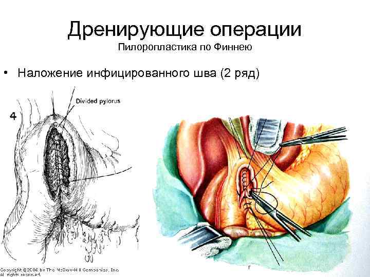 Дренирующие операции Пилоропластика по Финнею • Наложение инфицированного шва (2 ряд) 