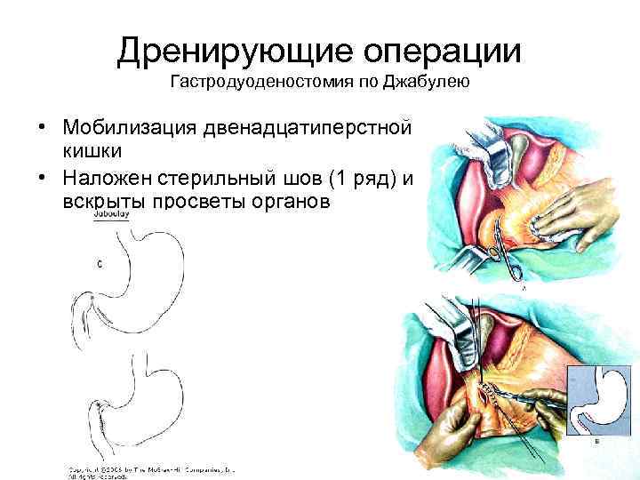 Дренирующие операции Гастродуоденостомия по Джабулею • Мобилизация двенадцатиперстной кишки • Наложен стерильный шов (1