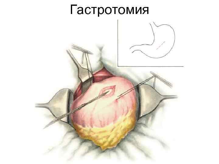 Гастротомия 