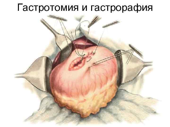 Гастротомия и гастрорафия 