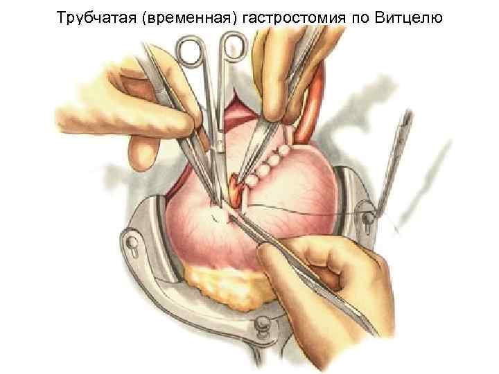 Трубчатая (временная) гастростомия по Витцелю 