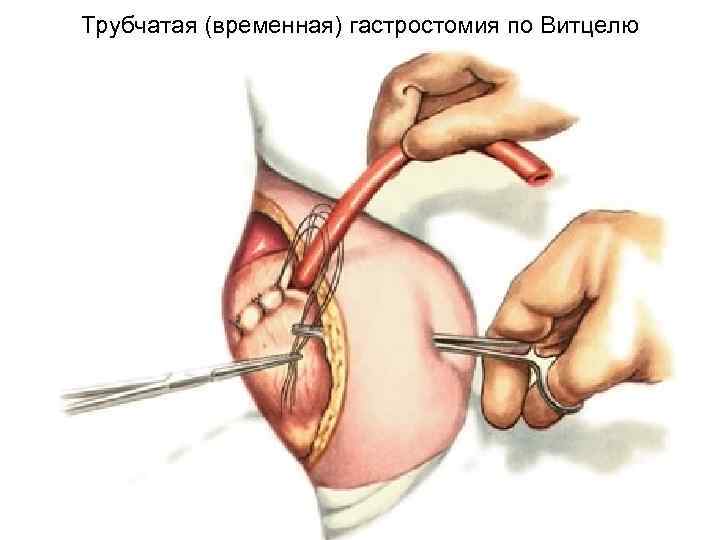Трубчатая (временная) гастростомия по Витцелю 