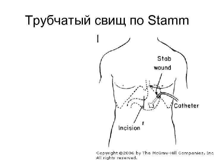 Трубчатый свищ по Stamm 