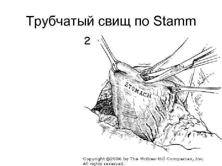 Трубчатый свищ по Stamm 