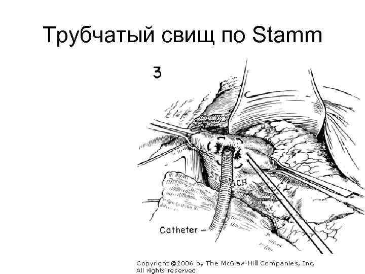 Трубчатый свищ по Stamm 