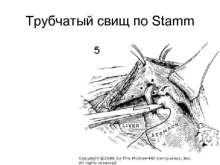 Трубчатый свищ по Stamm 