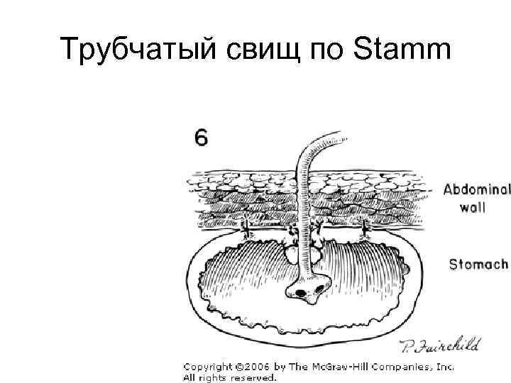 Трубчатый свищ по Stamm 