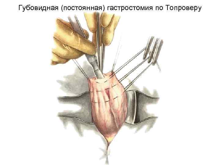 Губовидная (постоянная) гастростомия по Топроверу 