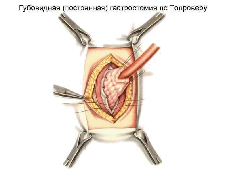 Губовидная (постоянная) гастростомия по Топроверу 