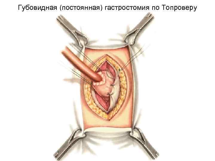 Губовидная (постоянная) гастростомия по Топроверу 