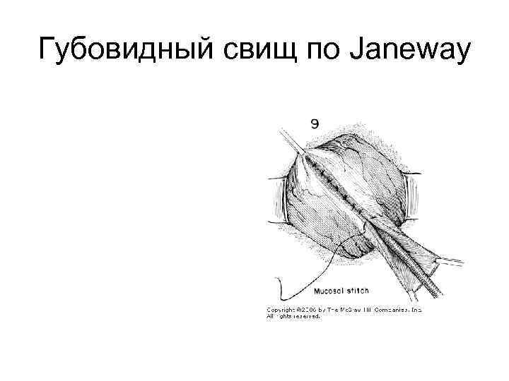 Губовидный свищ по Janeway 