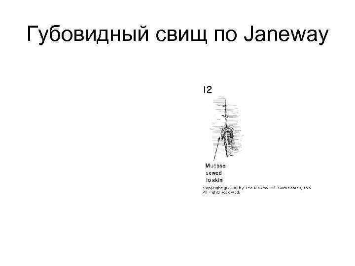 Губовидный свищ по Janeway 