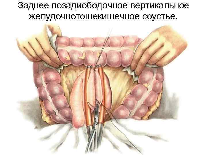 Заднее позадиободочное вертикальное желудочнотощекишечное соустье. 
