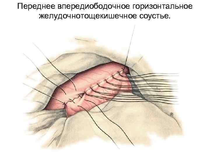 Переднее впередиободочное горизонтальное желудочнотощекишечное соустье. 