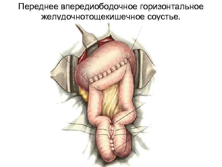 Переднее впередиободочное горизонтальное желудочнотощекишечное соустье. 