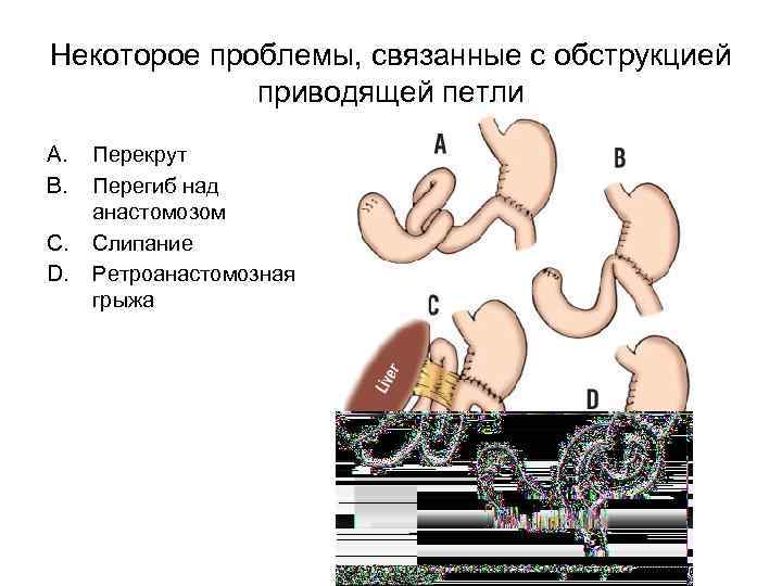 Некоторое проблемы, связанные с обструкцией приводящей петли A. B. C. D. Перекрут Перегиб над