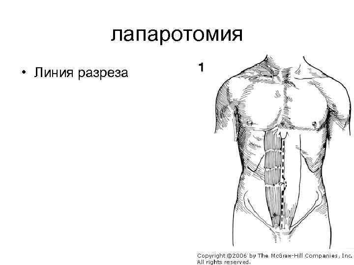 лапаротомия • Линия разреза 